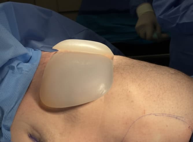 Pectoral implants in Albania