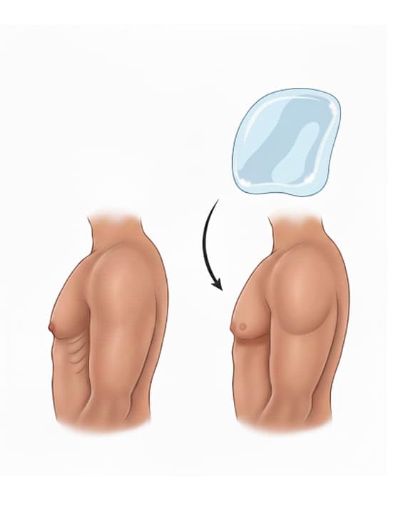 Affordable pectoral implants in Albania