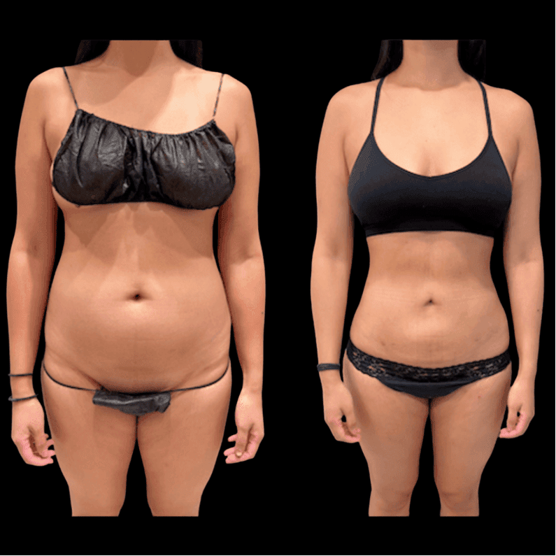 360 Liposuzione in Albania