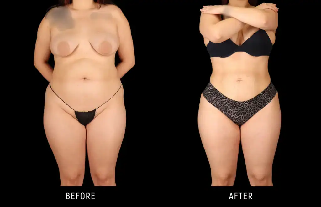 Liposuksion 360 në Shqipëri