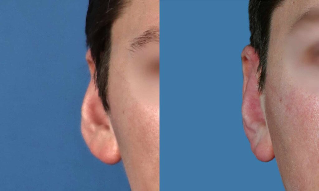 before and after male otoplasty in Albania