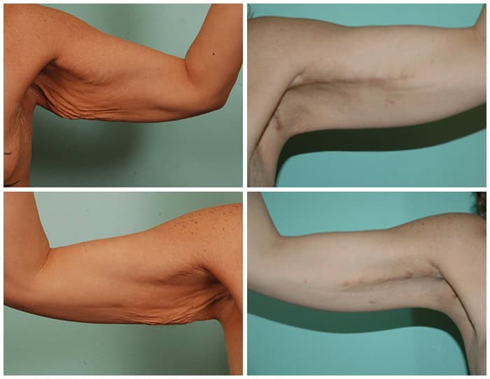 Arm lift surgery in Albania results before and after both arms Brachioplasty