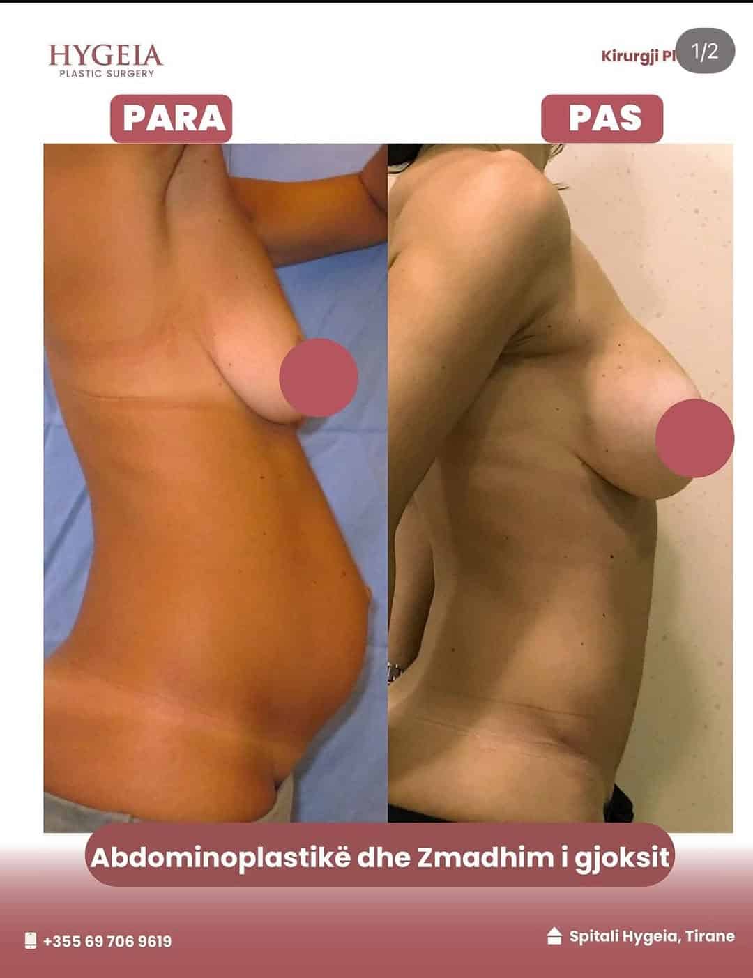 Before and after breast enlargement and liposuction