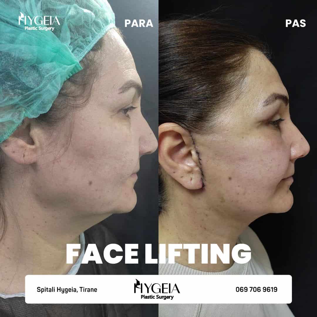Before and after facelift