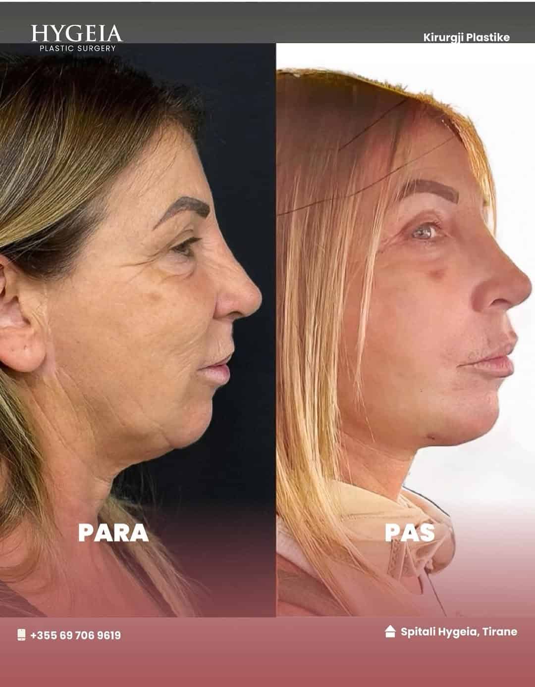 Before and after facelift