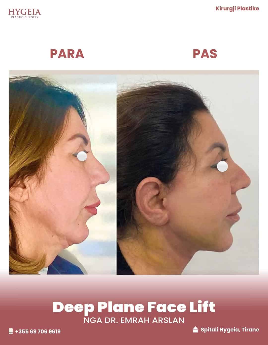 Before and after facelift