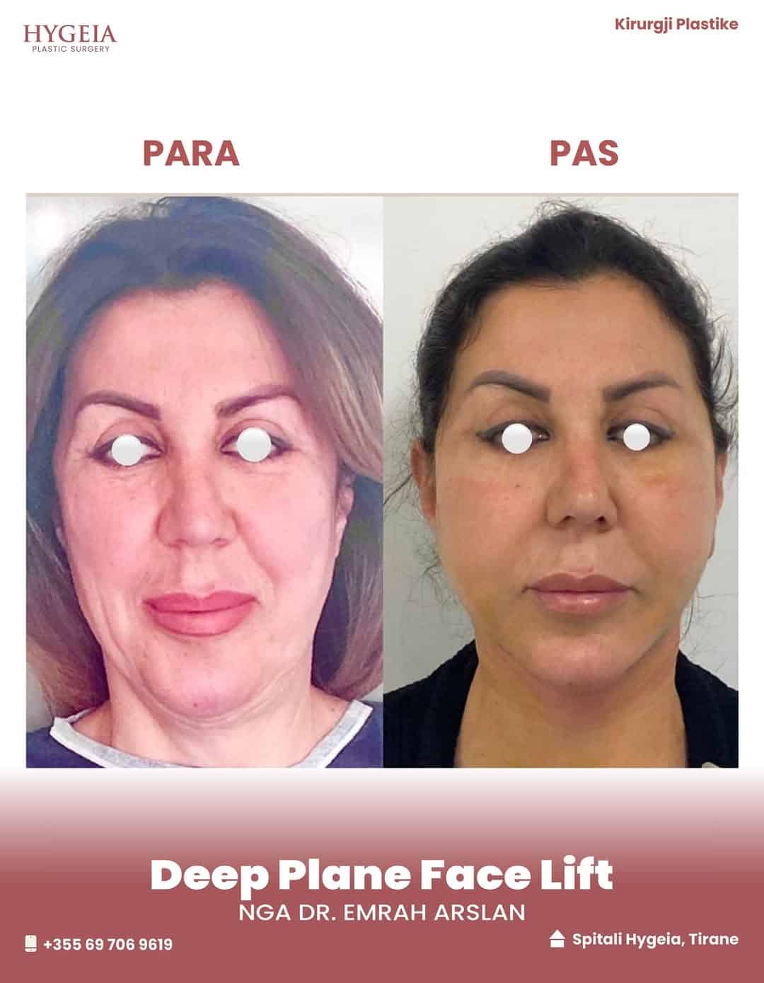 Before and after facelift