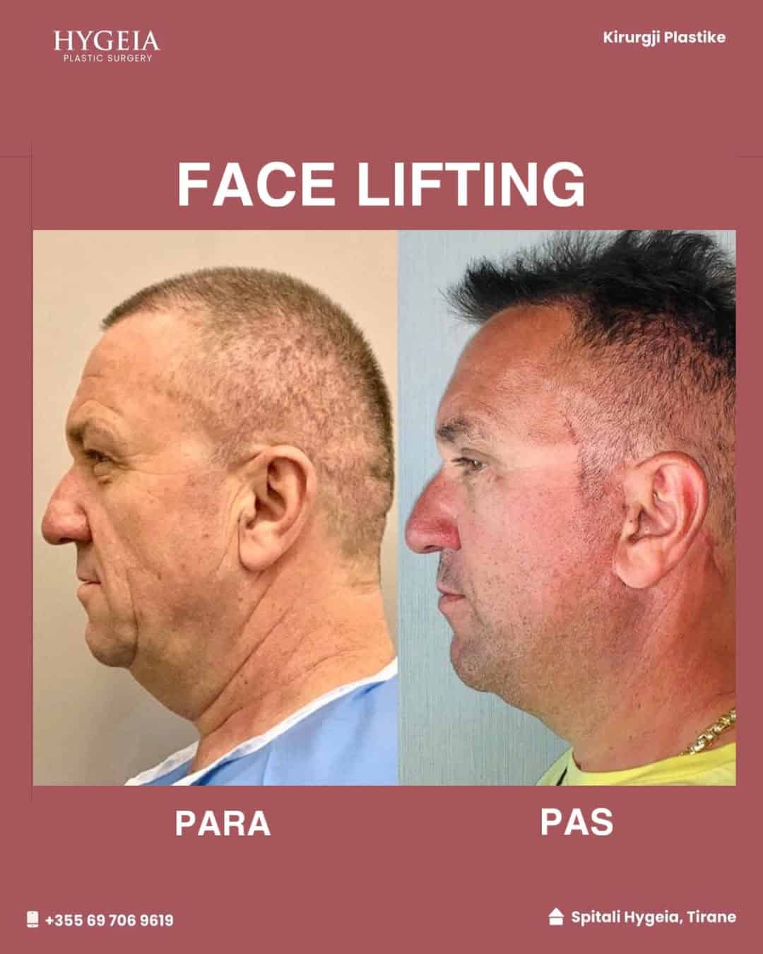 Before and after facelift