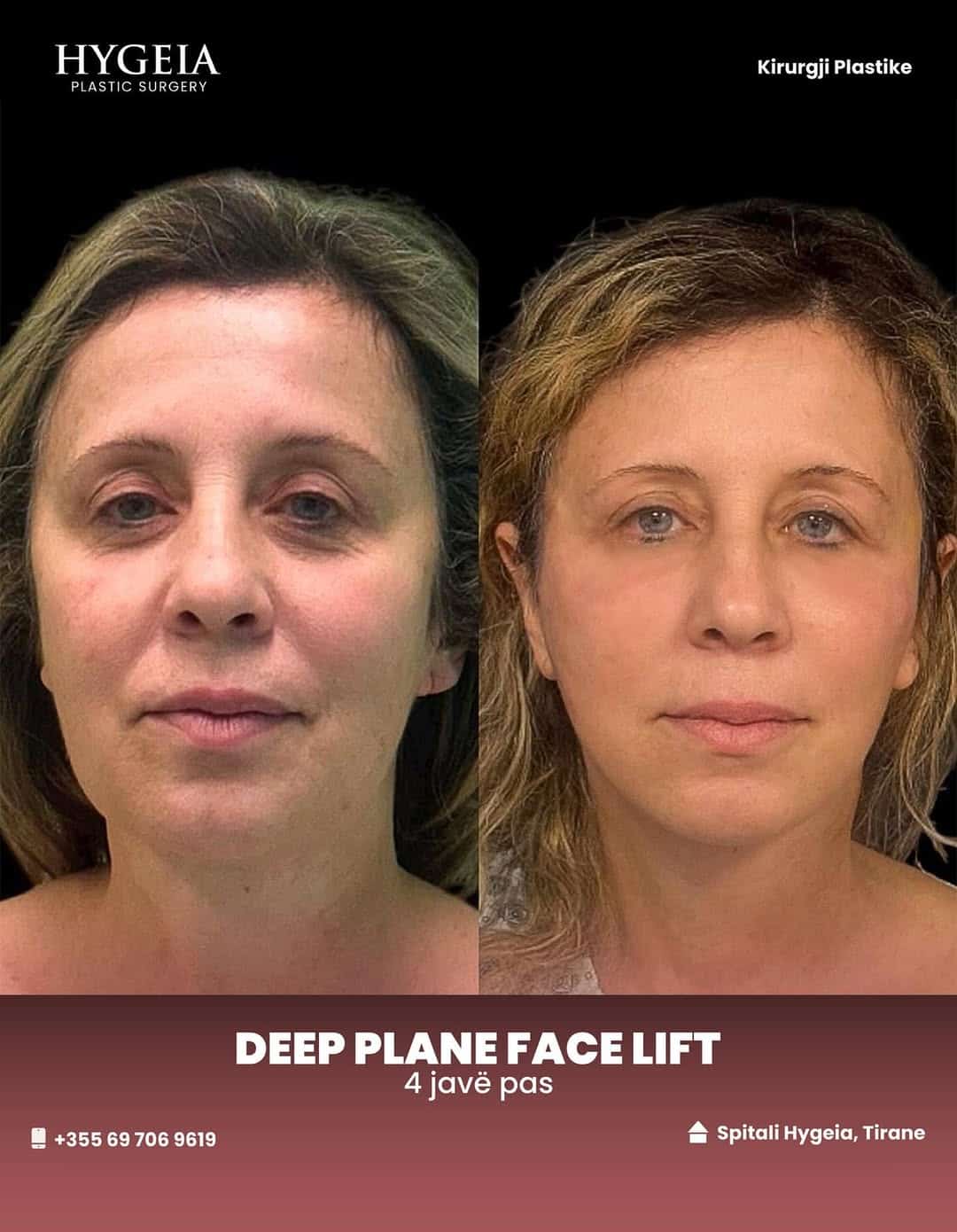 Before and after facelift