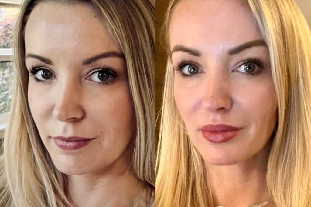 Before and after lip lift in Albania