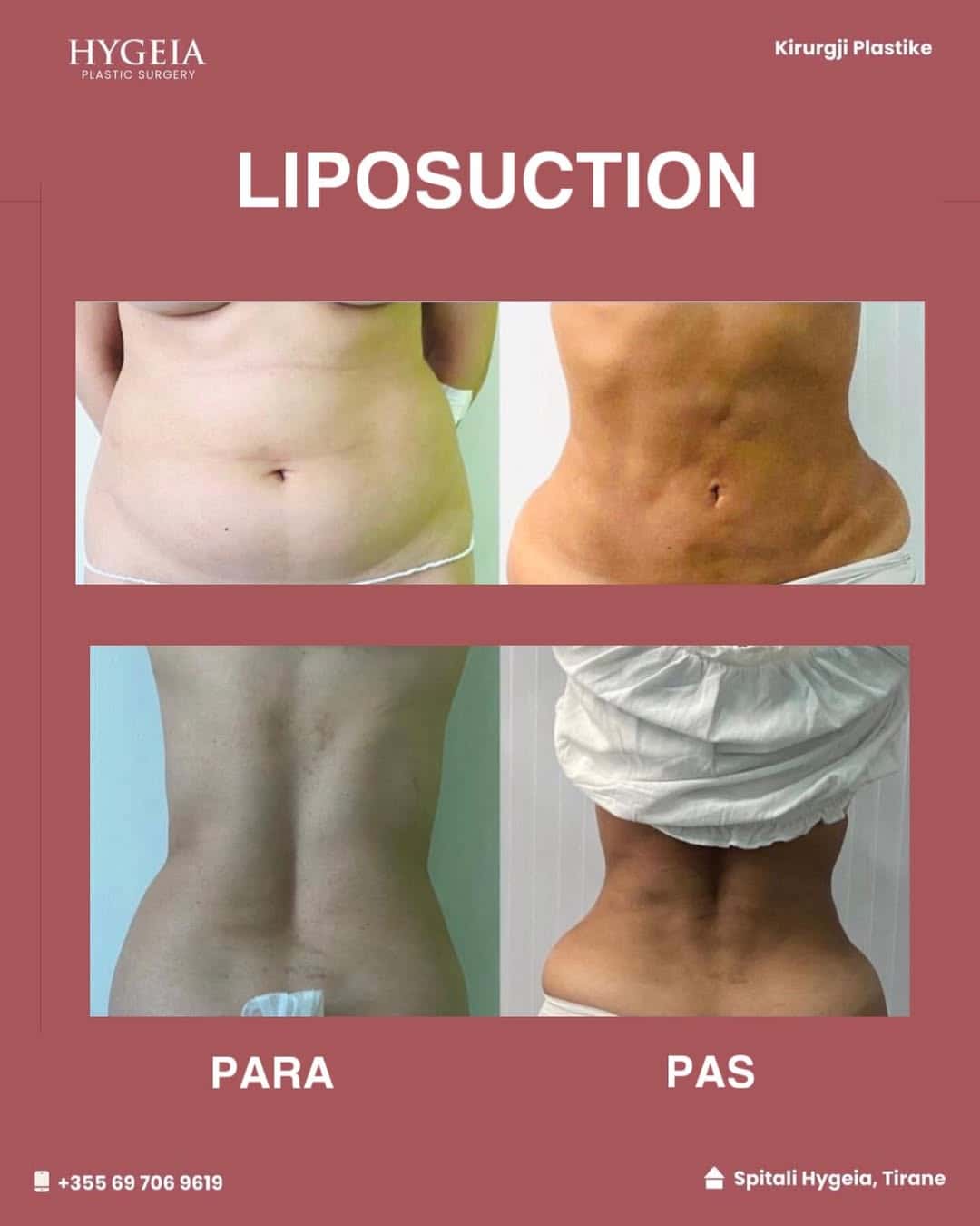 Before and after liposuction in Albania