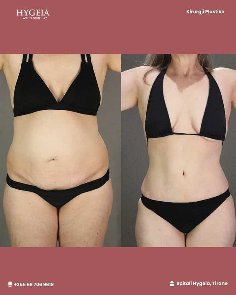 Before and after liposuction in Albania