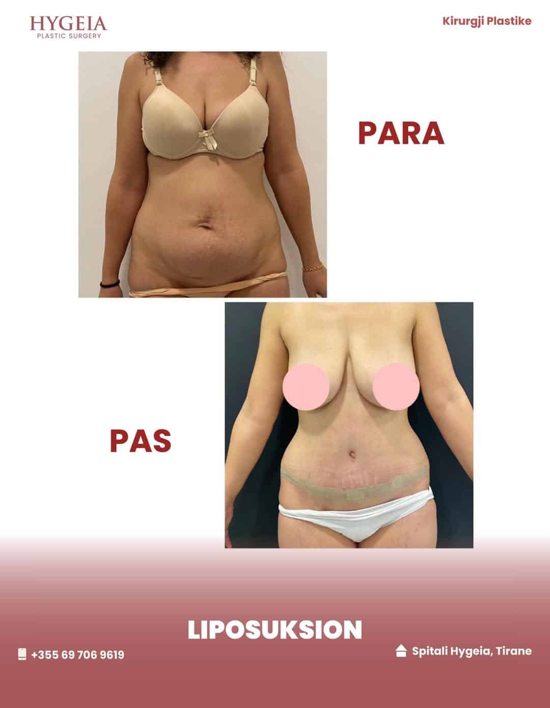 Before and after liposuction in Albania