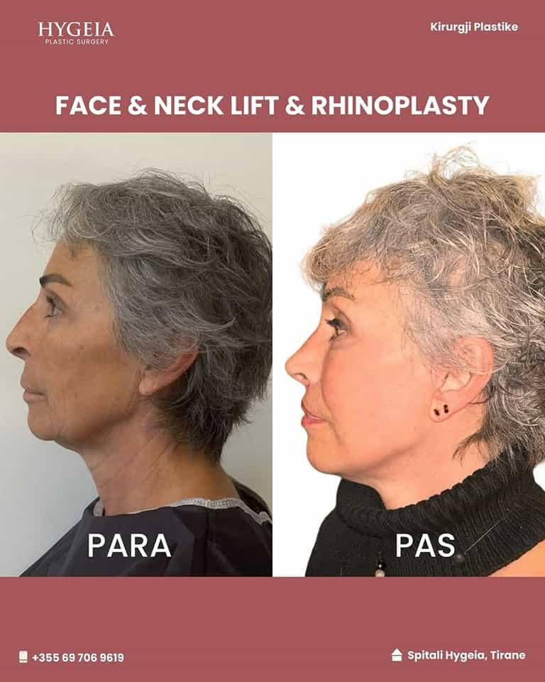 Before and after neck lift