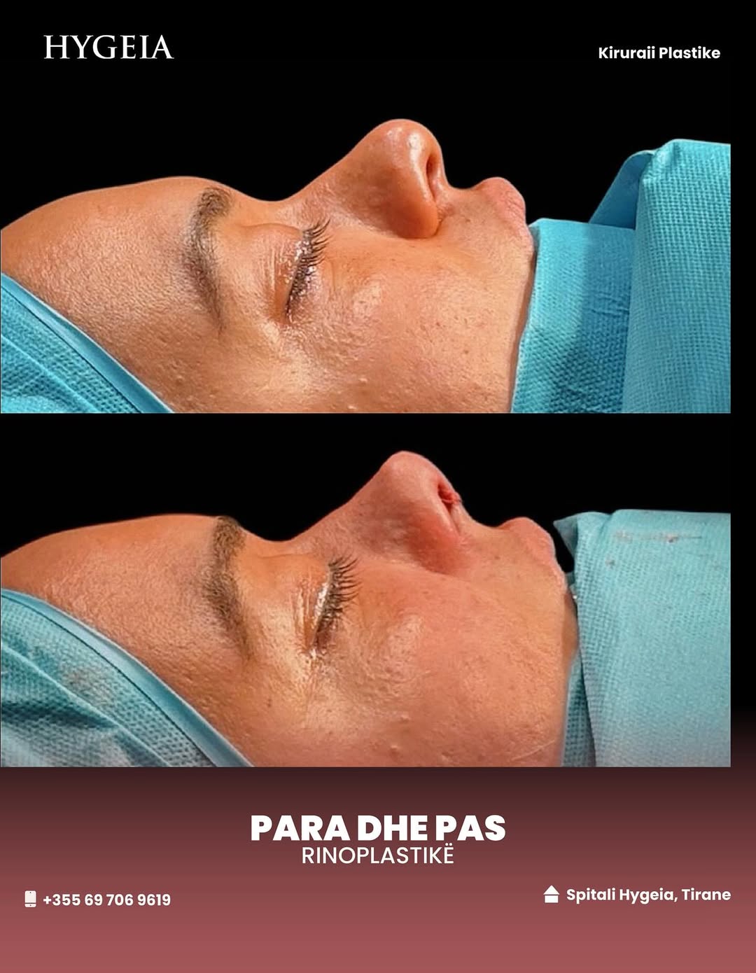 Before and after rhinoplasty in Albania