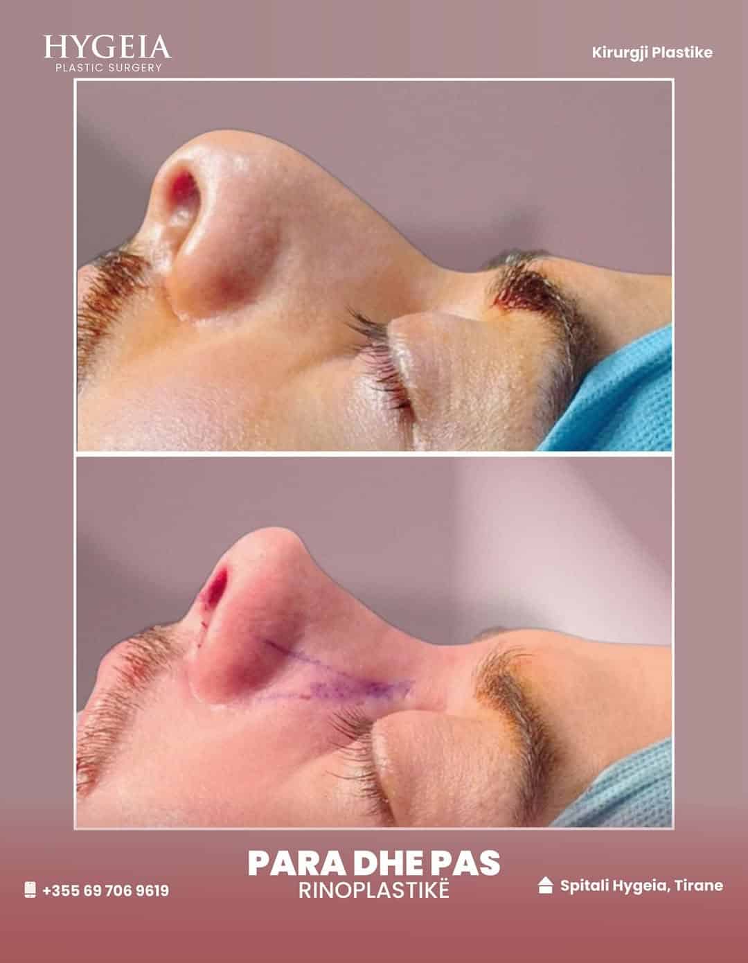 Para dhe pas rinoplastikës në Shqipëri