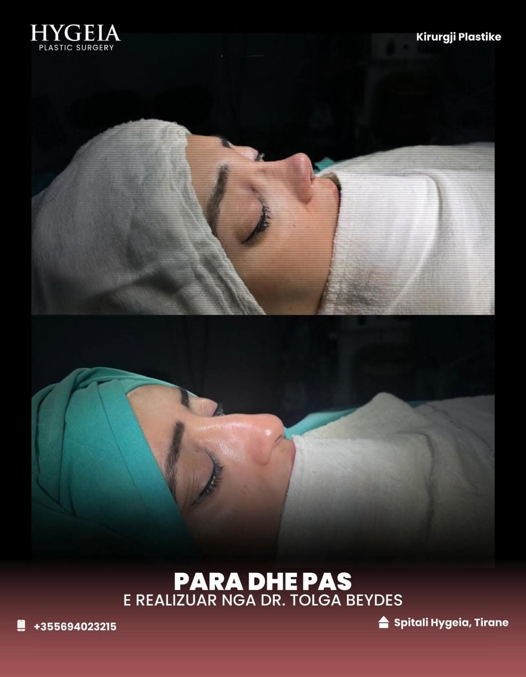 Before and after rhinoplasty in Albania