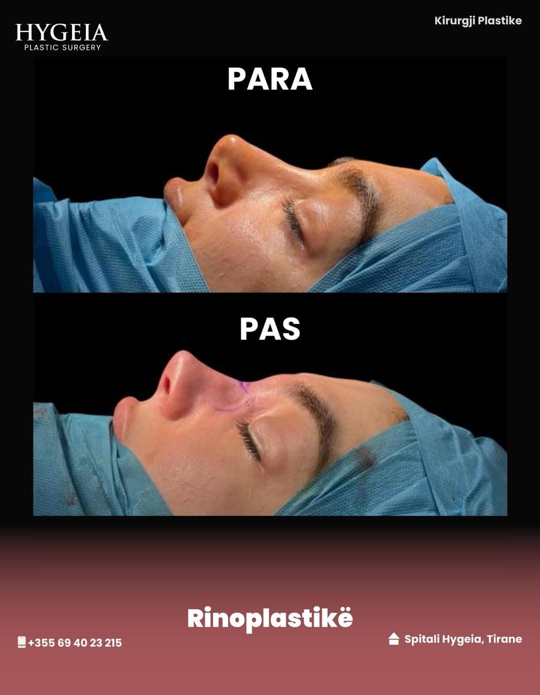 Before and after rhinoplasty in Albania