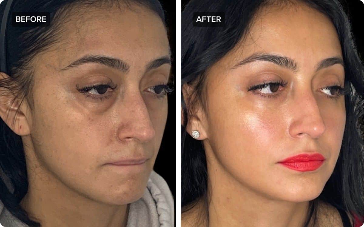 Before and after face fat transfer results