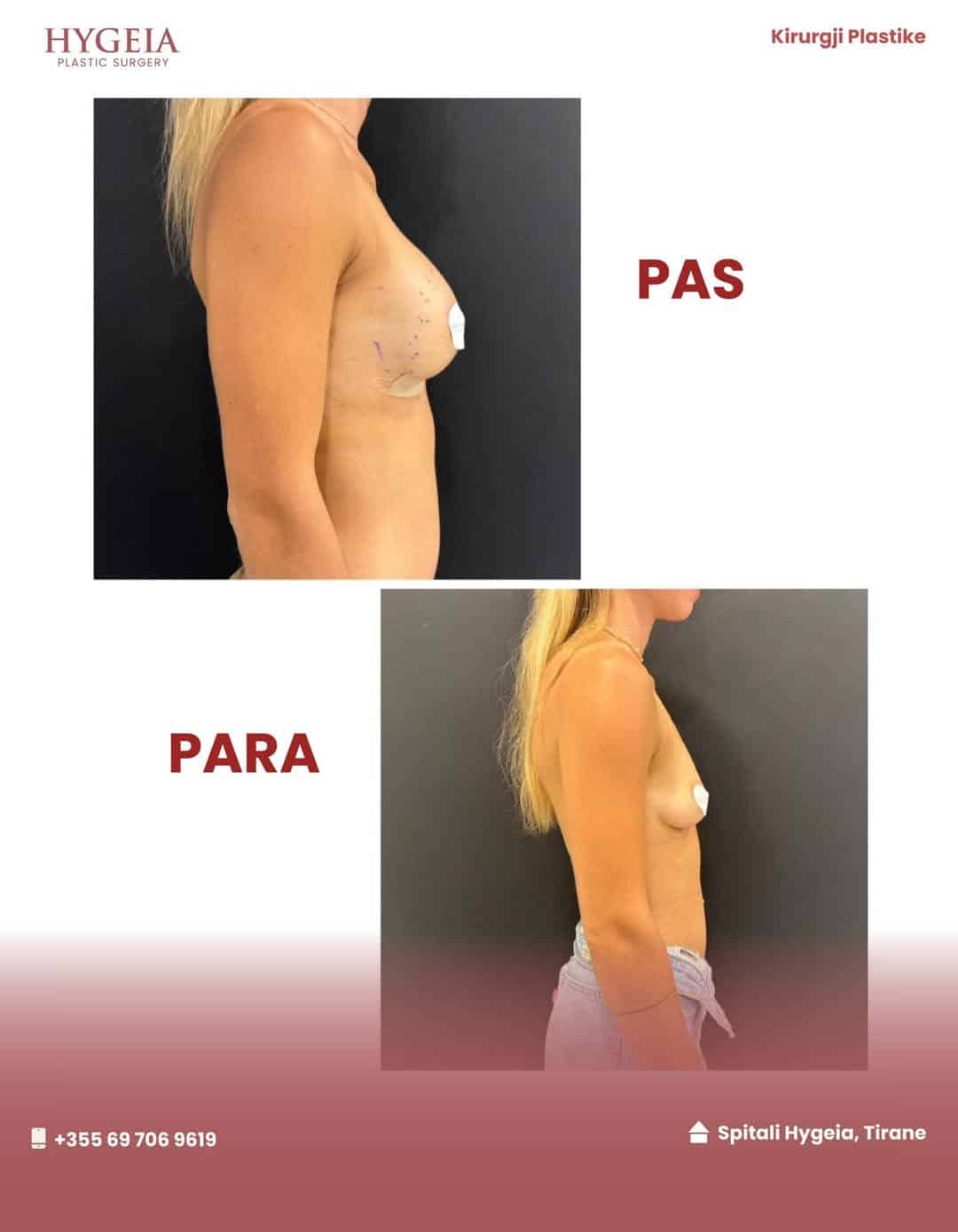 Kirurgjia e Zmadhimit të Gjirit në Shqipëri