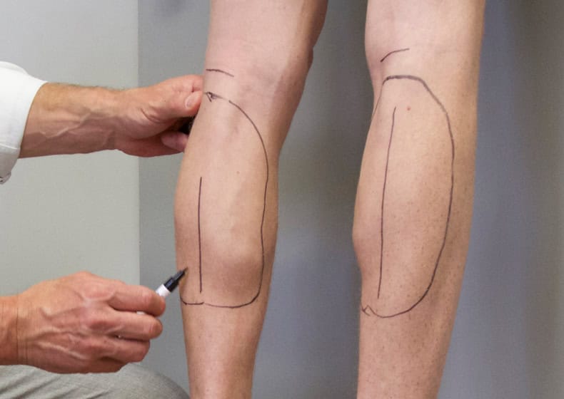Doctor marking legs for calf implants