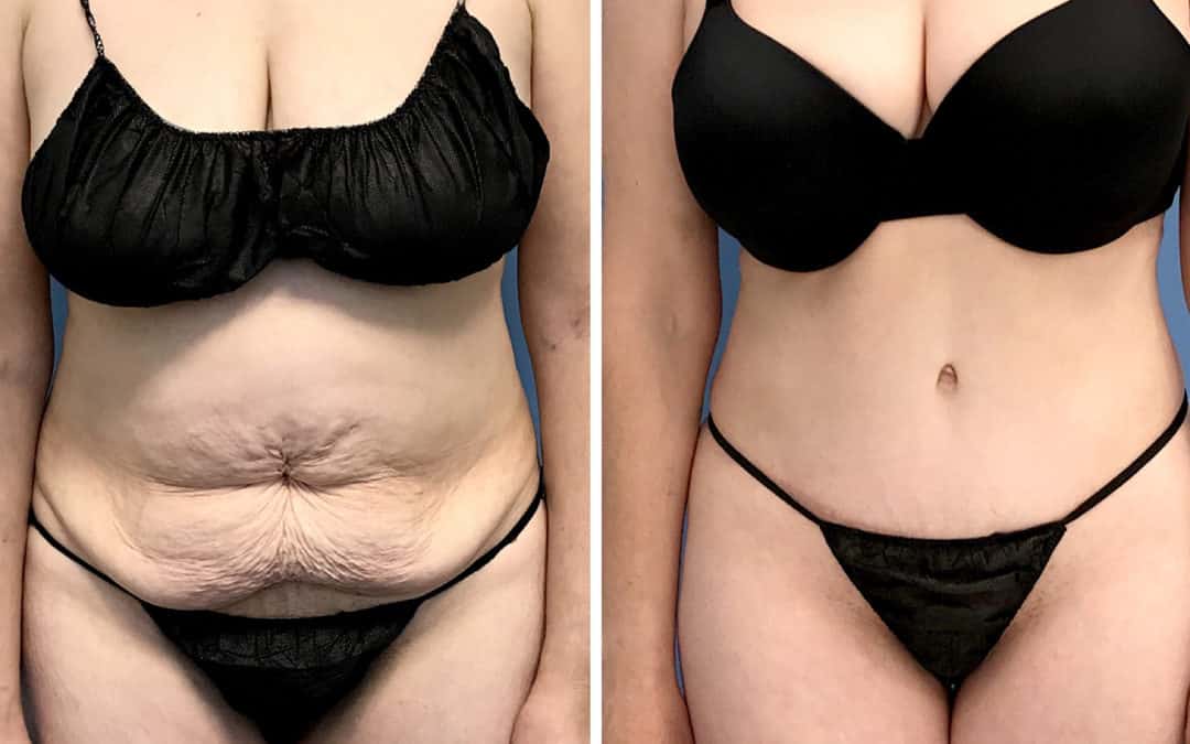 Extended Tummy Tuck Before After Results