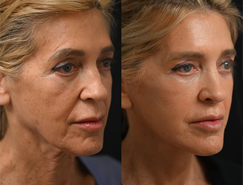 Face Fat Transfer in Albania