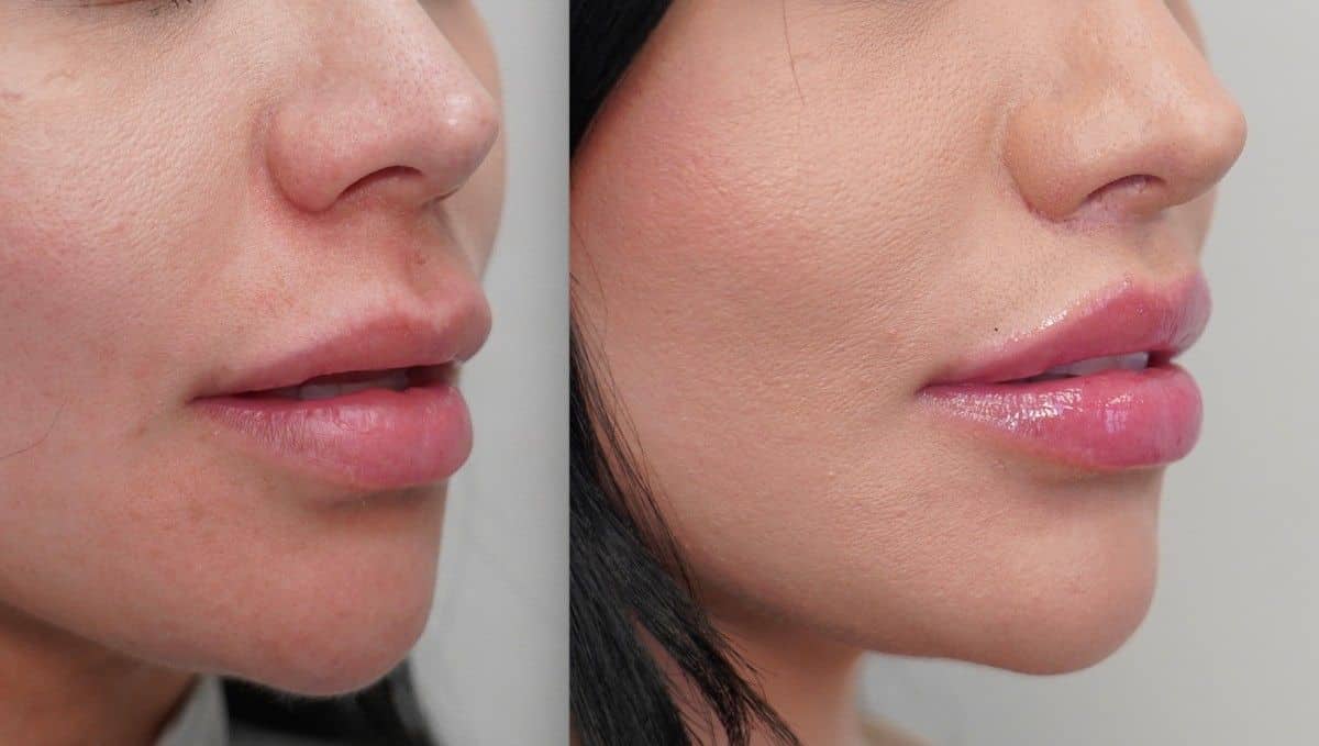 Lip Lift Result