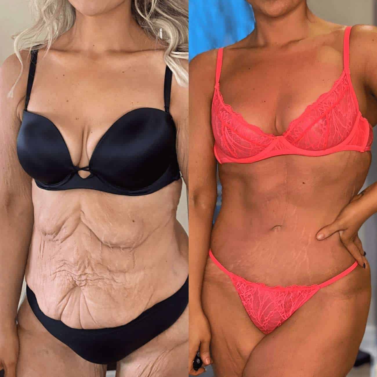 Mommy Makeover Results Before after photo