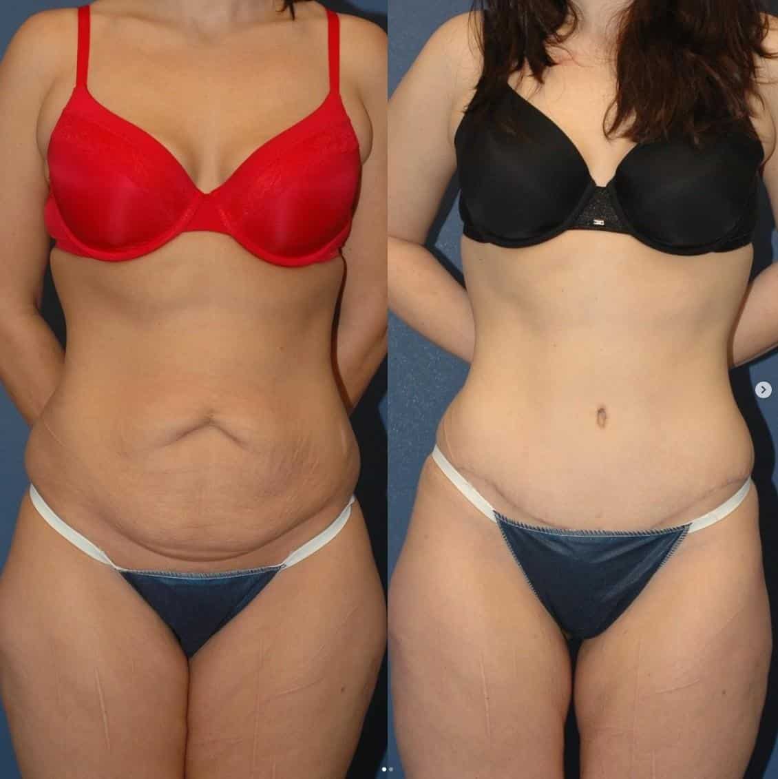 Mommy Makeover in Albania amazing results