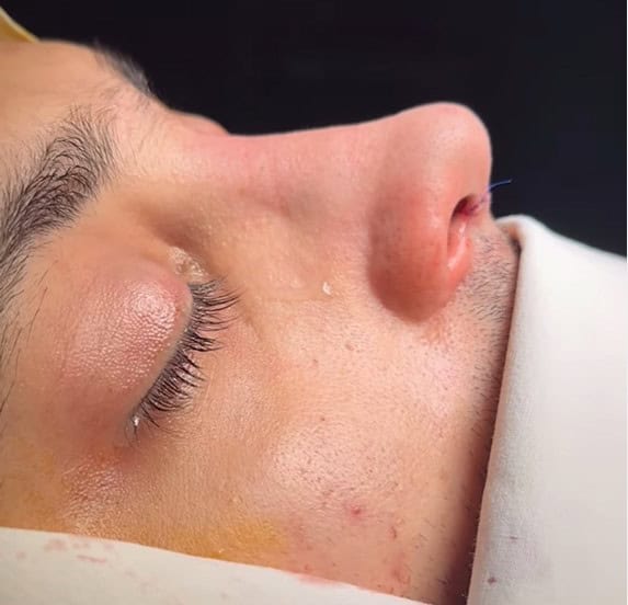 Nose Tip Rhino results in Tirana, Albania