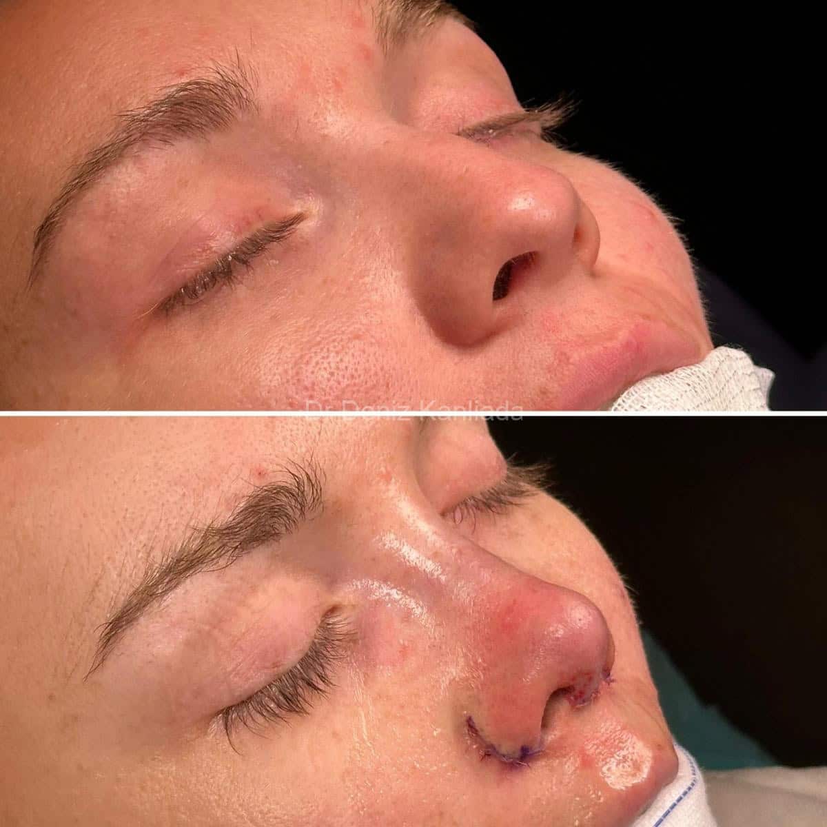 Nose Tip Rhinoplasty Results