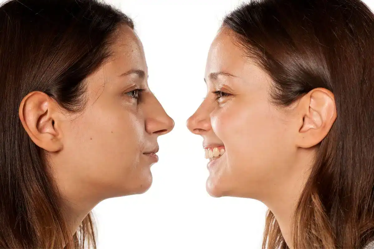 Nose Tip Rhinoplasty in Albania