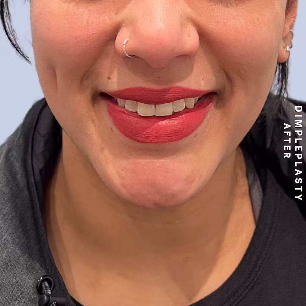 Results after Dimpleplasty