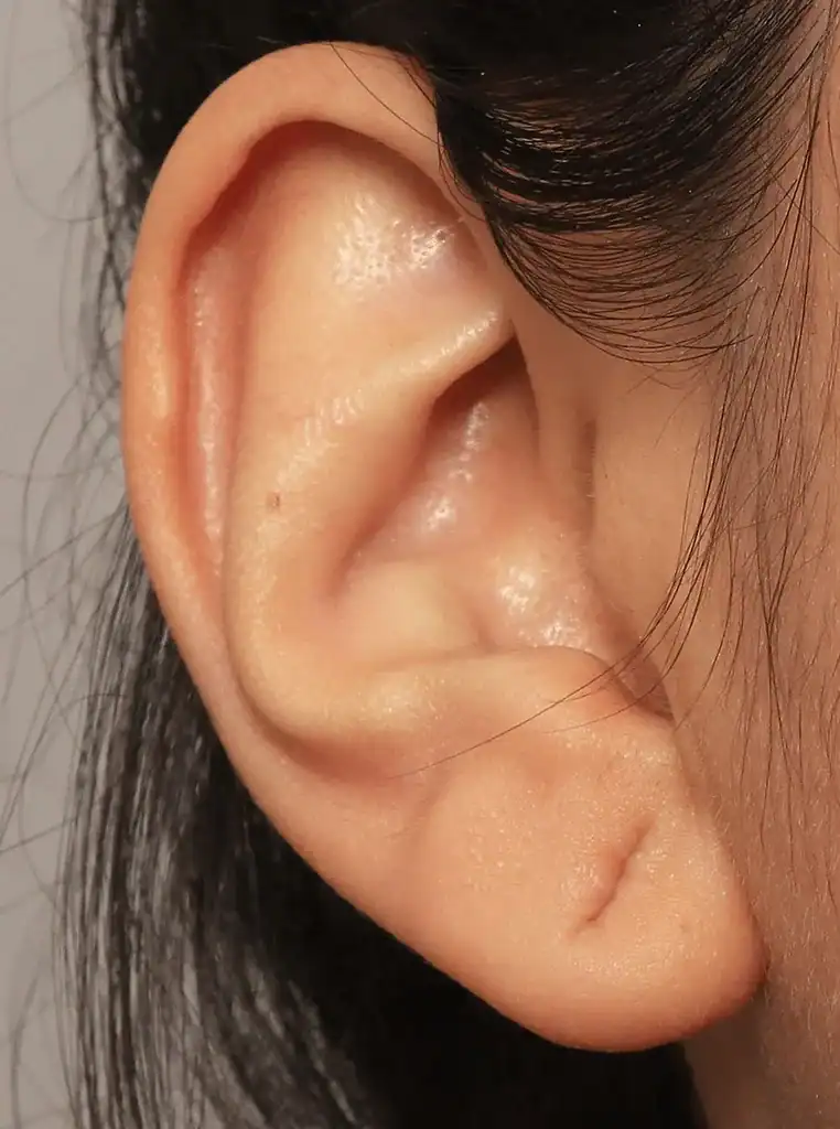 Rezultatet pas riparimit të veshit