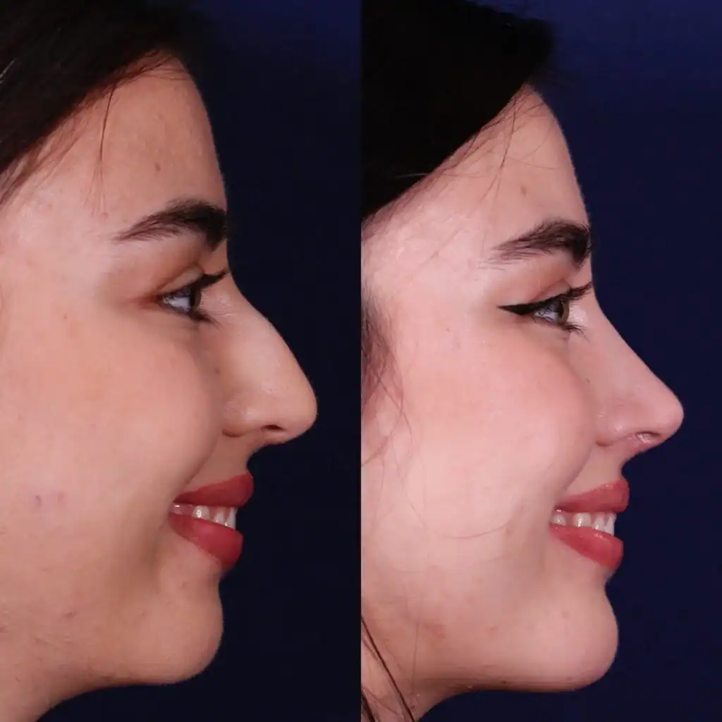 Septoplasty Results in Female patient before and after