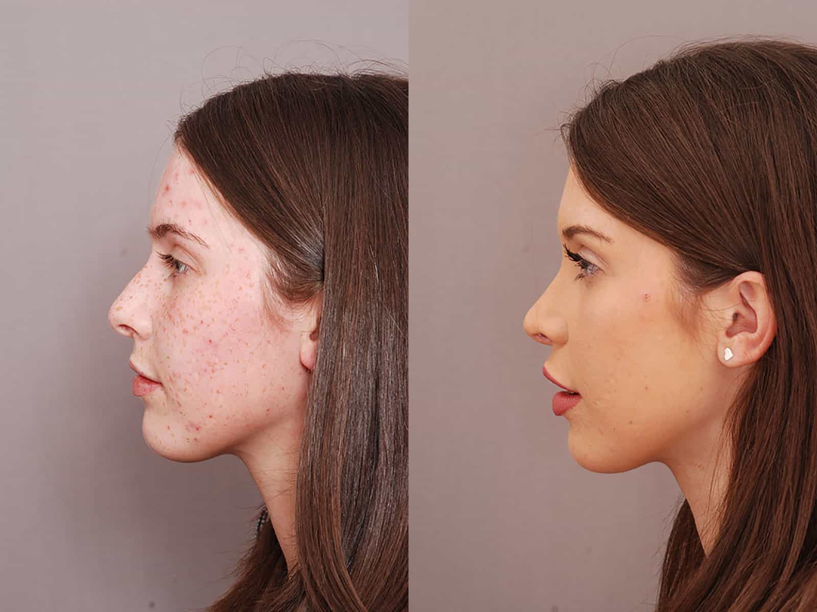 Septorhinoplasty Results