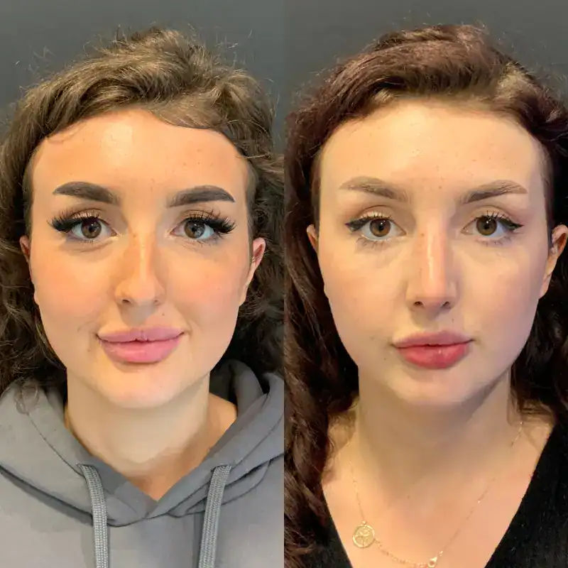 Septorhinoplasty Surgery in Albania