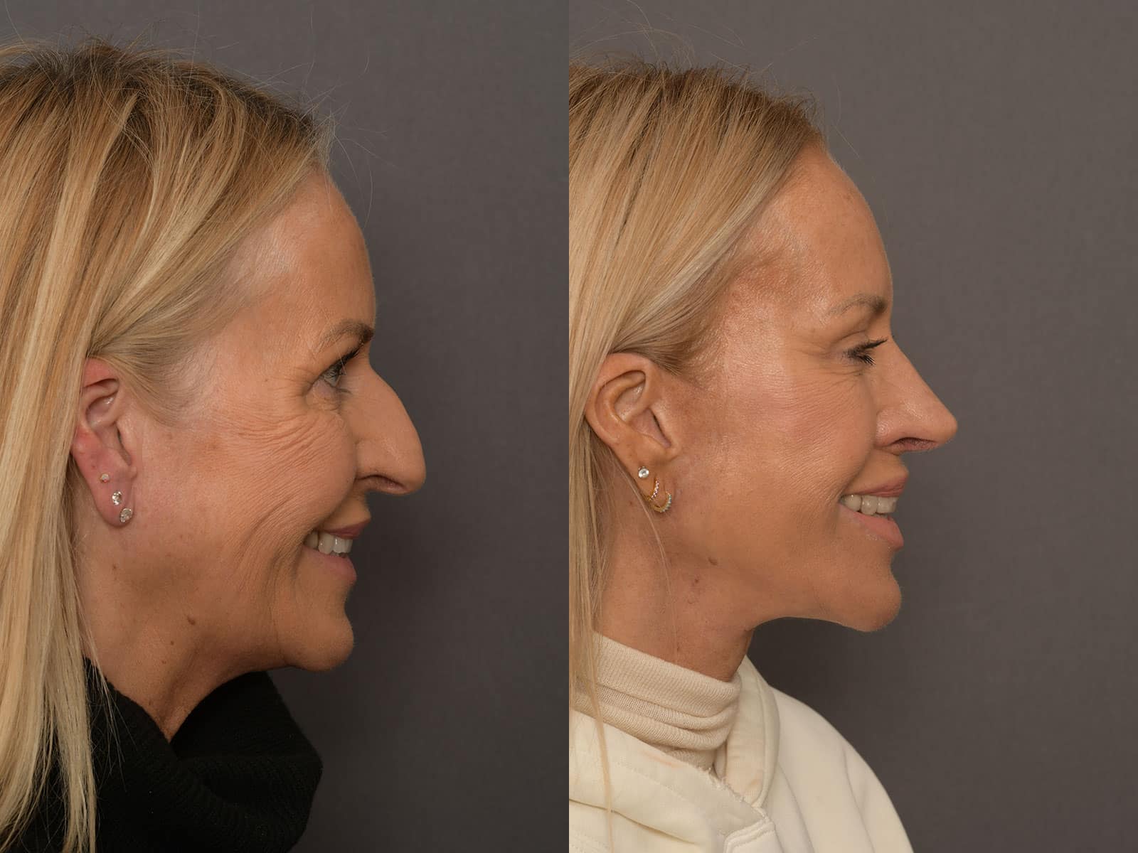Septorhinoplasty before and after