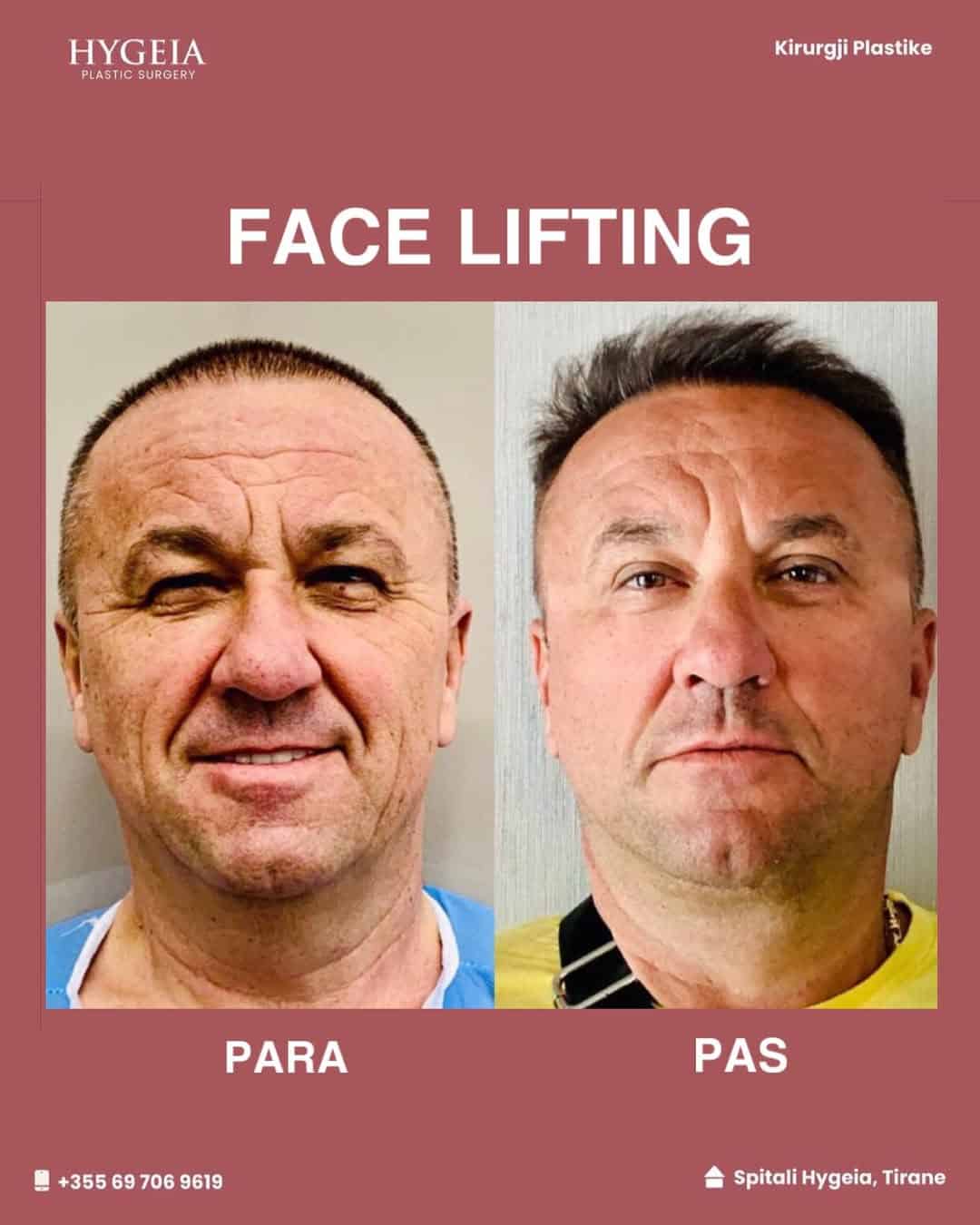 Lifting fytyre para dhe pas për meshkuj në Shqipëri, rezultate të mahnitshme