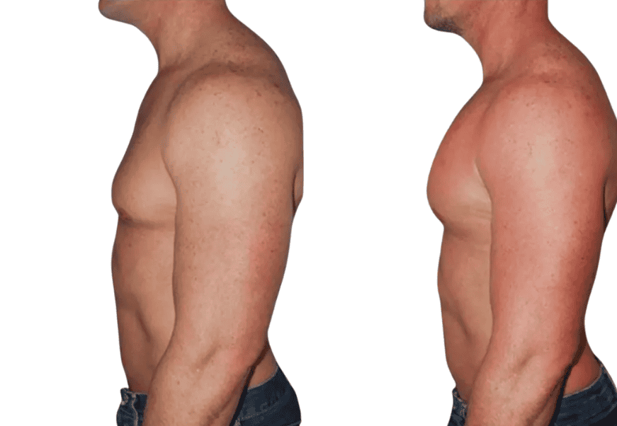 before and after pectoral implants in Albania