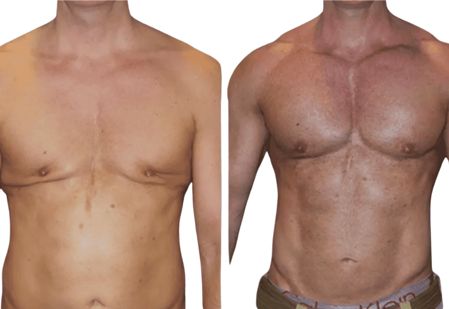 Muscular chest implants for men in Albania