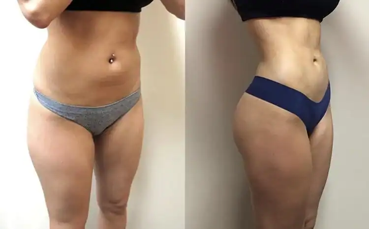 Vaser Liposuction Results