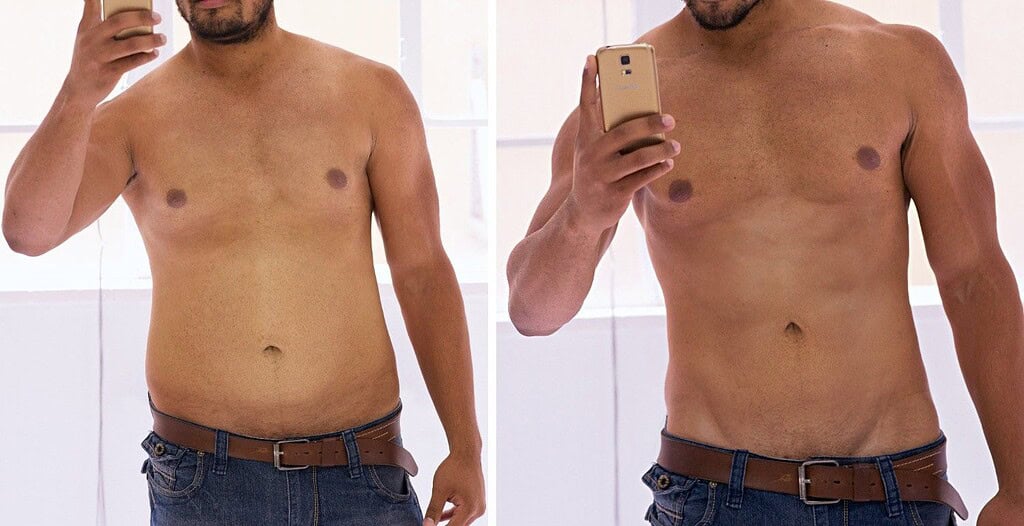 Male stomach fat removal in Albania
